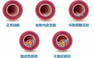 动脉硬化在哪里（动脉硬化在哪里最据有隐秘性）