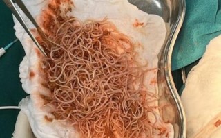 蛔虫面哪里有（蛔虫面哪里有卖）