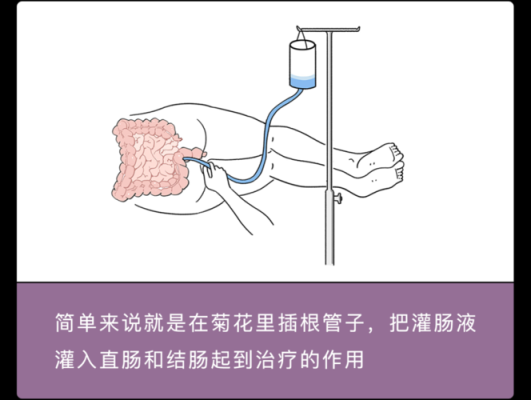 哪里可以灌肠（医院哪里可以灌肠）-第3张图片-厨房小当家