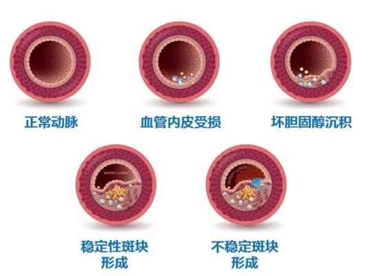 动脉硬化在哪里(动脉硬化在哪里最据有隐秘性)-第1张图片-厨房小当家 动脉硬化在哪里(动脉硬化在哪里最据有隐秘性)-第1张图片-厨房小当家