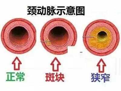 动脉硬化在哪里(动脉硬化在哪里最据有隐秘性)-第2张图片-厨房小当家 动脉硬化在哪里(动脉硬化在哪里最据有隐秘性)-第2张图片-厨房小当家
